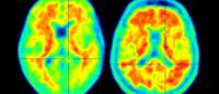 brain scans showing amyloid deposits related to Alzheimer's disease