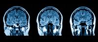MRI images of the brain