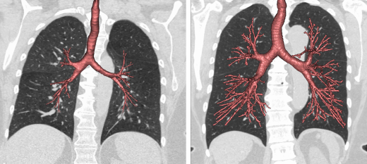 Undersized Airways May Explain Why Nonsmokers Get COPD | Columbia ...
